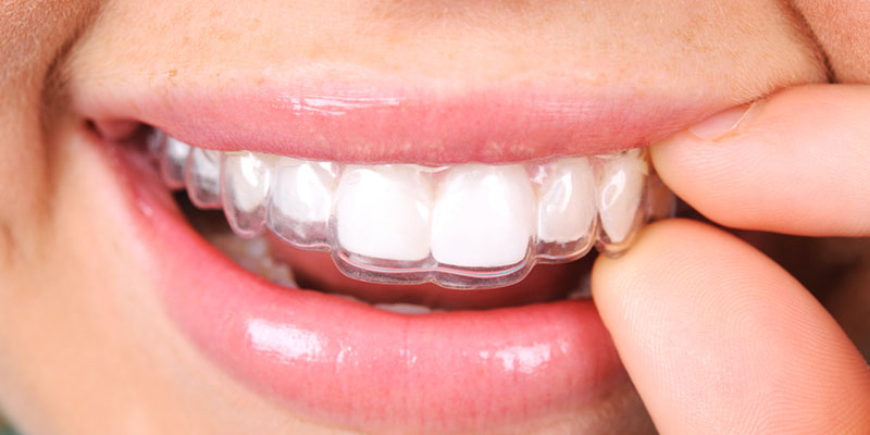 We offer Invisalign® to our patients