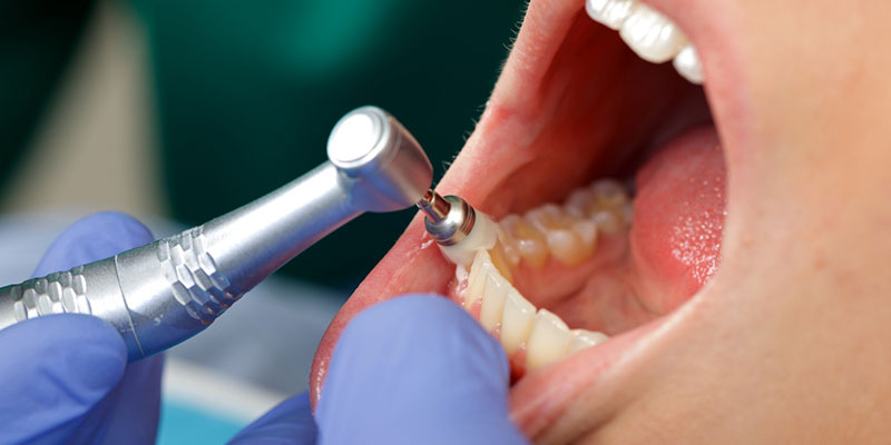 Teeth Cleaning Will Keep Your Smile Healthy