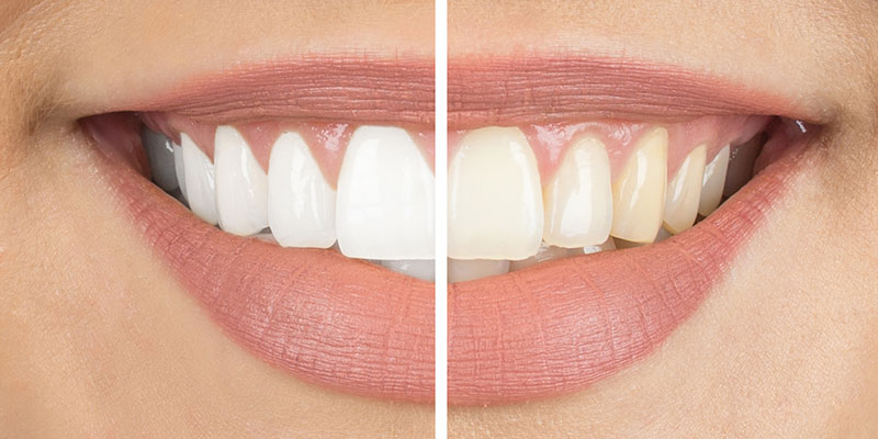Get A Bright Smile with Teeth Whitening