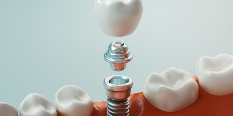 Dental Implants in Cary, North Carolina