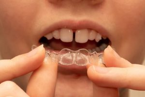Is Invisalign the Best Choice for Your Teen?