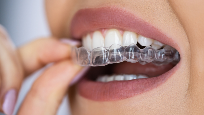 Six Tips For Invisalign Success